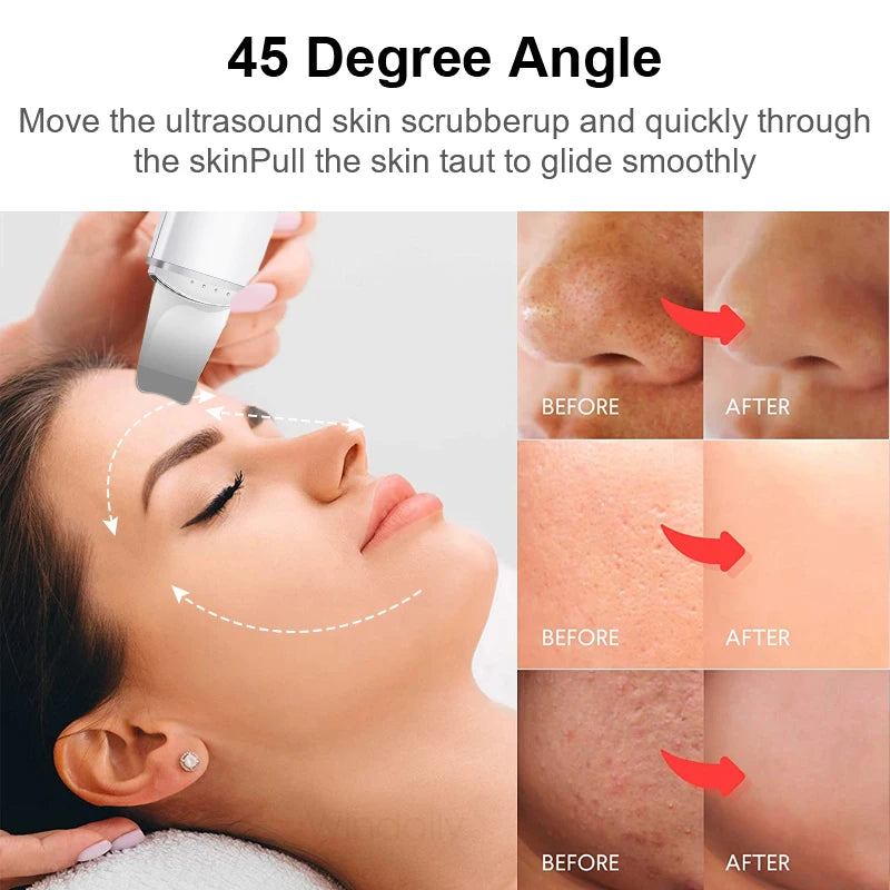 Ultrasonic Skin Scrubber – Deep Clean & Lift